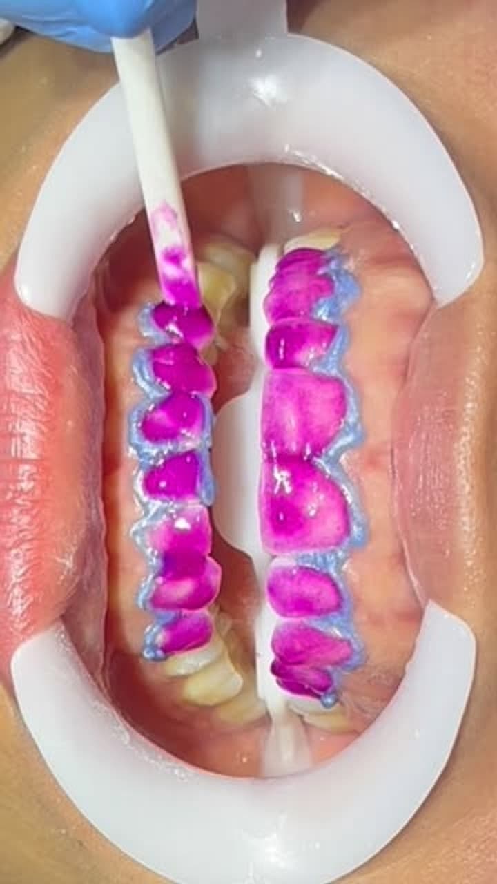 Clareamento dental