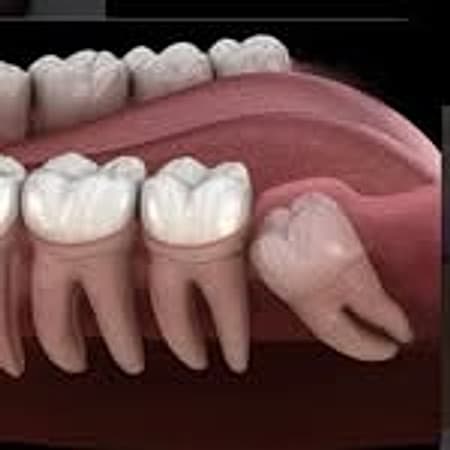 Exodontia de dente do siso